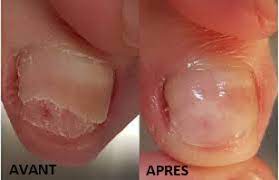 Ongle reconstruit par onychoplastie