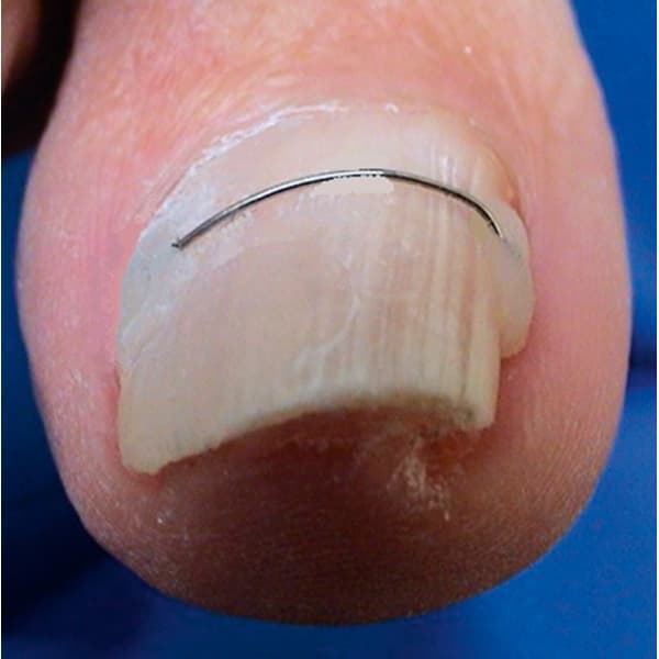 Fil en titane posé sur un ongle pour une orthonyxie