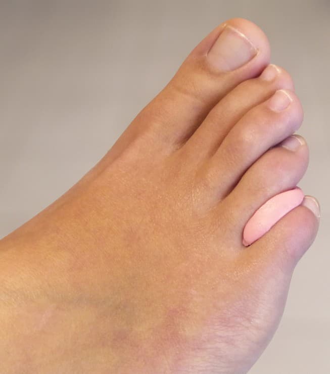Orthoplastie en silicone sur mesure
